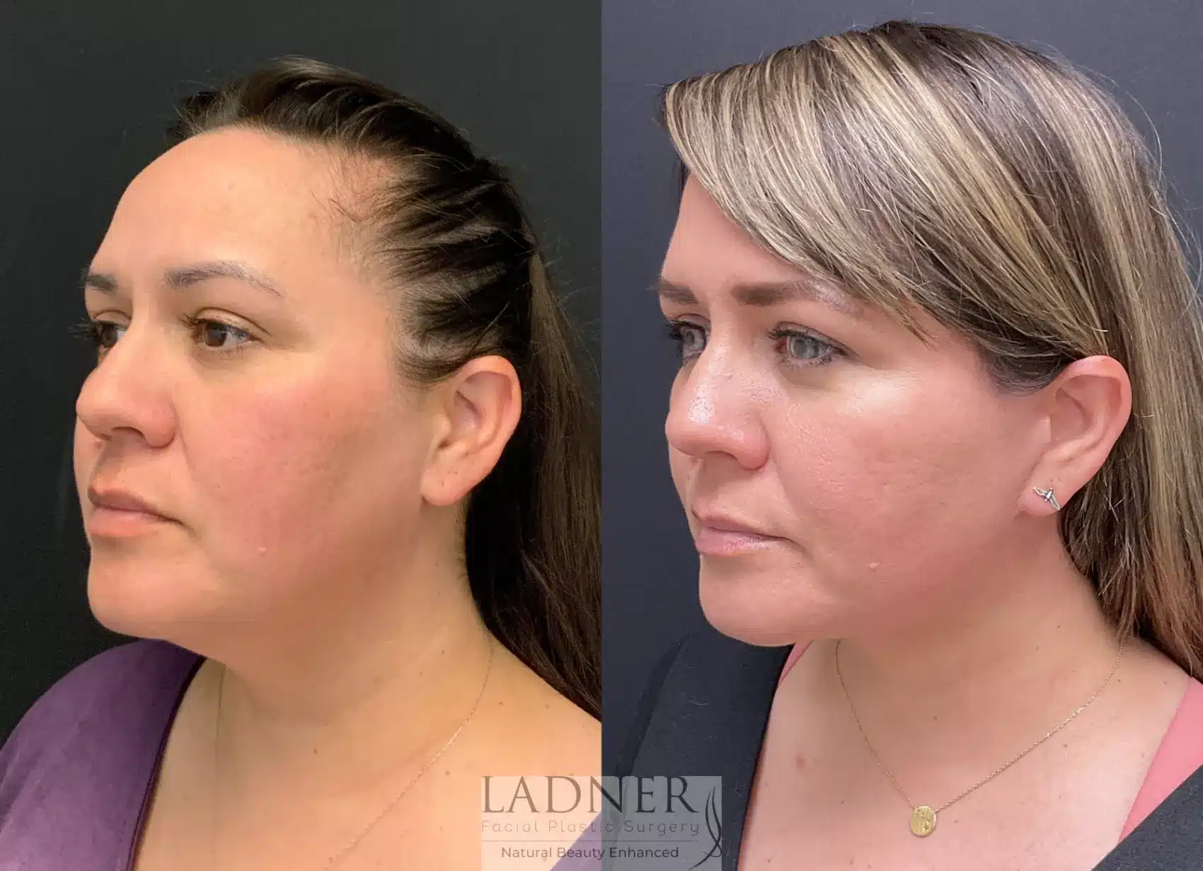 Before and After Image: Deep Plane Facelift / Neck Lift - left-front-oblique