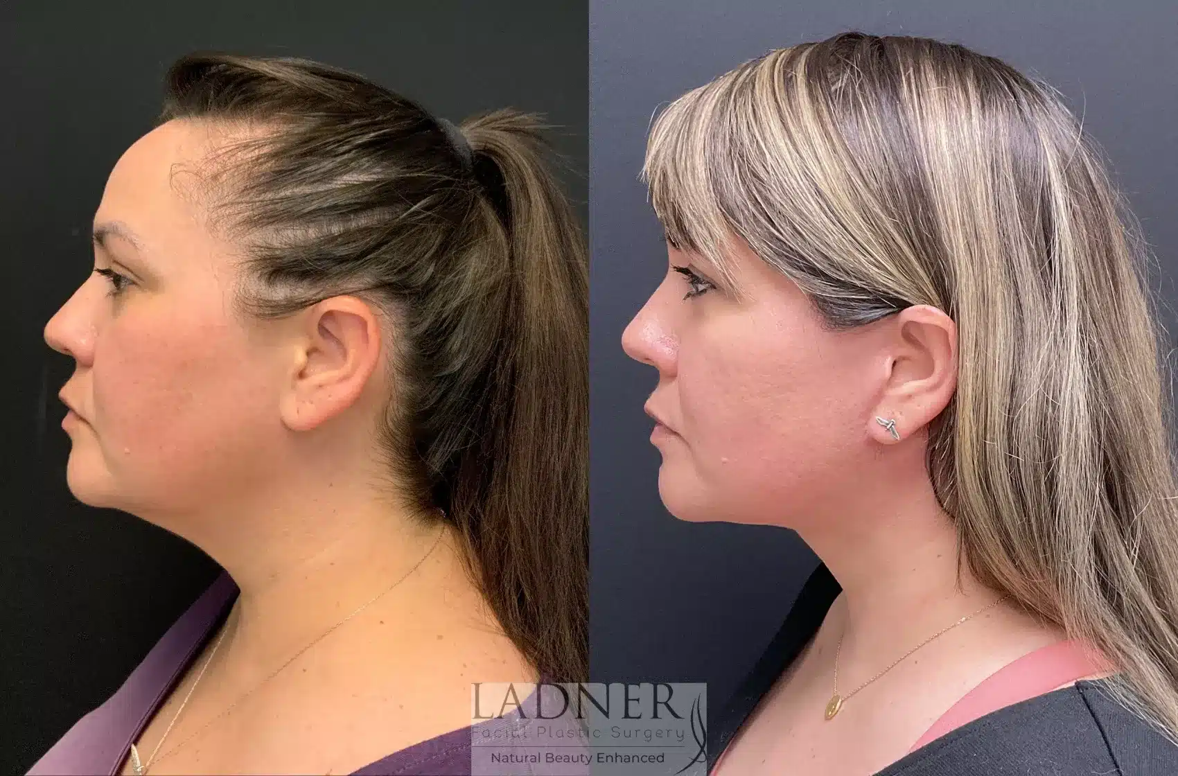 Before and After Image: Deep Plane Facelift / Neck Lift - left-side