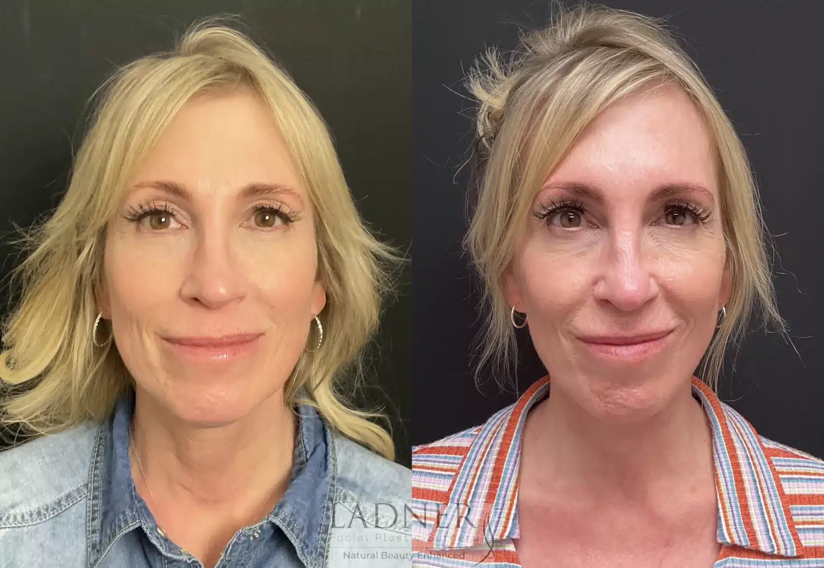 Before and After Image: Deep Plane Neck Lift - front