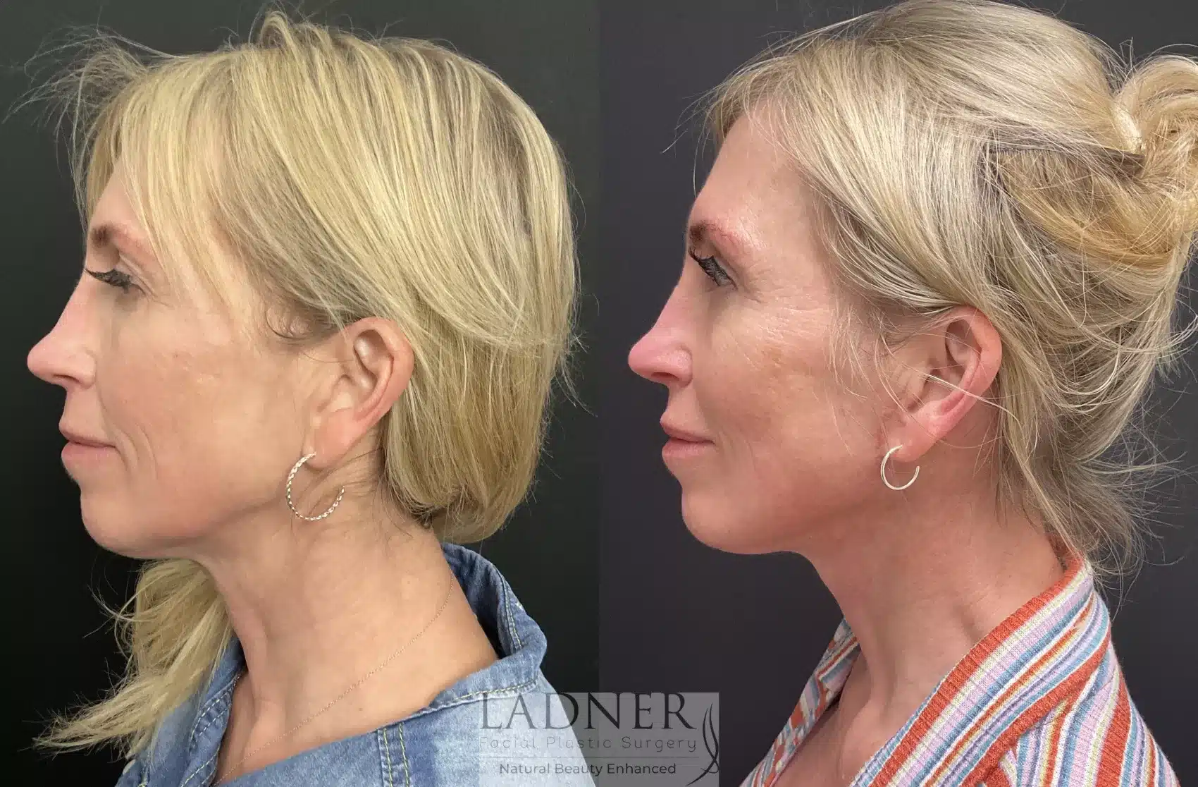 Before and After Image: Deep Plane Neck Lift - left-side