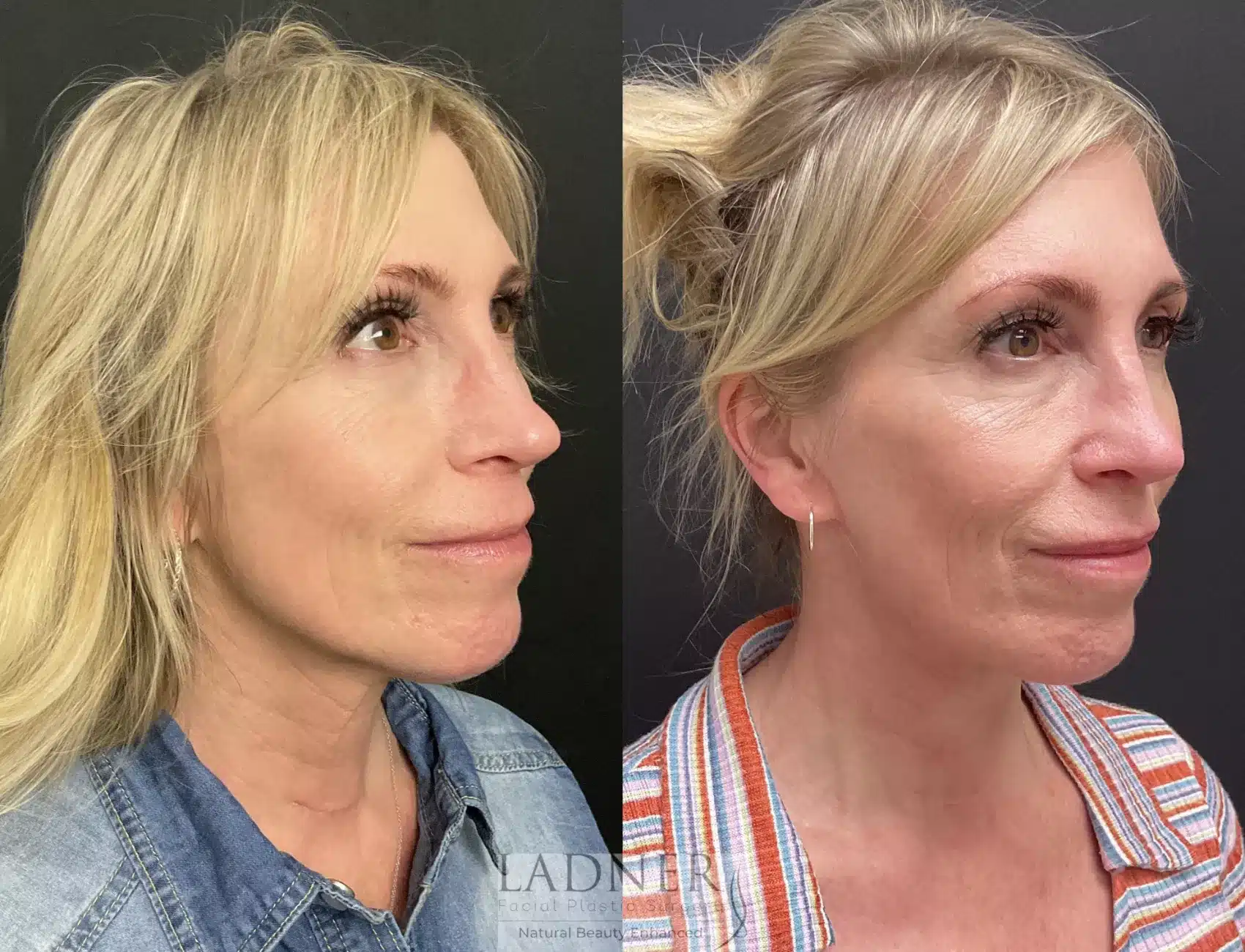 Before and After Image: Deep Plane Neck Lift - right-front-oblique