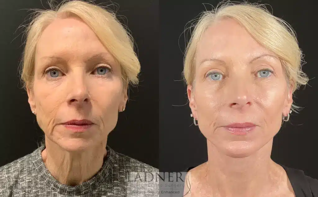 Before and After Image: Deep Plane Facelift & Chin Augmentation - front