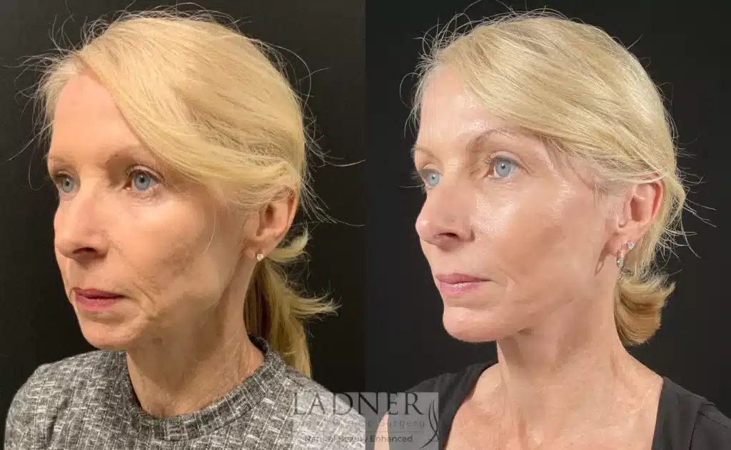 Before and After Image: Deep Plane Facelift & Chin Augmentation - left-front-oblique