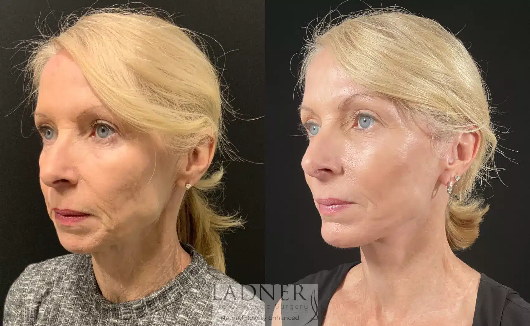 Before and After Image: Deep Plane Facelift - left-front-oblique