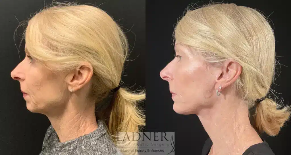 Before and After Image: Deep Plane Facelift & Chin Augmentation - left-side