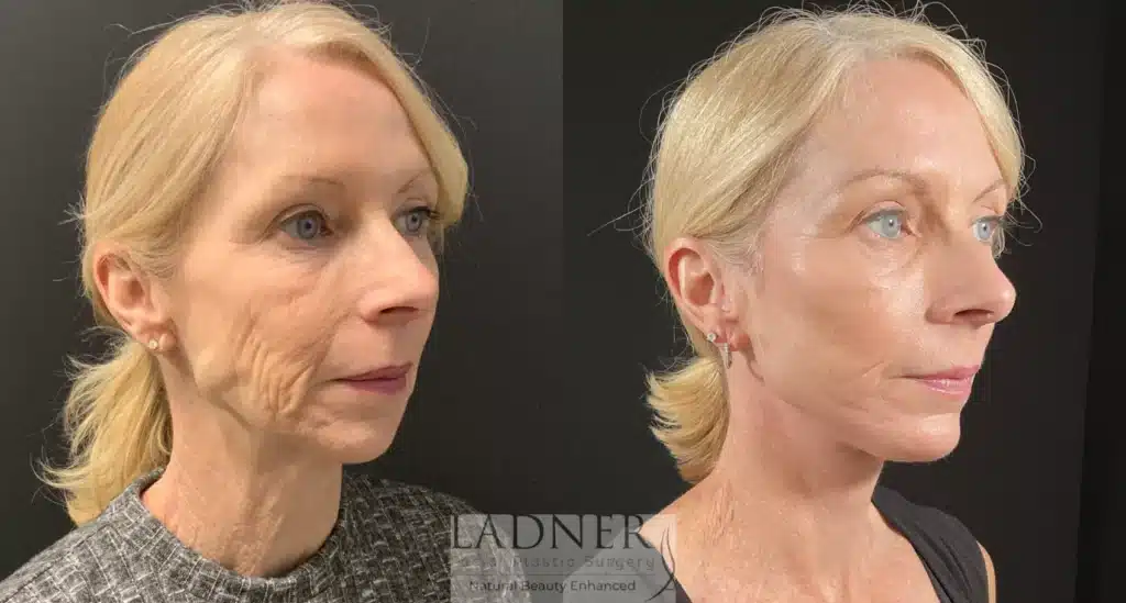 Before and After Image: Deep Plane Facelift & Chin Augmentation - right-front-oblique