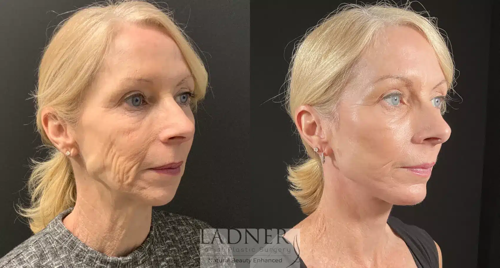 Before and After Image: Deep Plane Facelift - right-front-oblique
