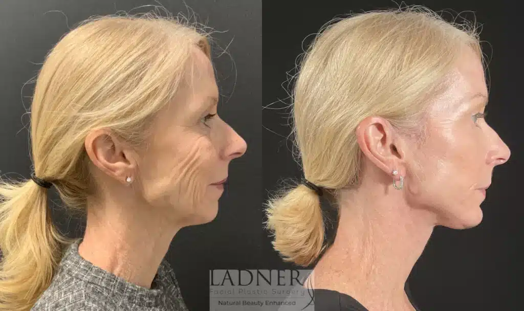 Before and After Image: Deep Plane Facelift & Chin Augmentation - right-side