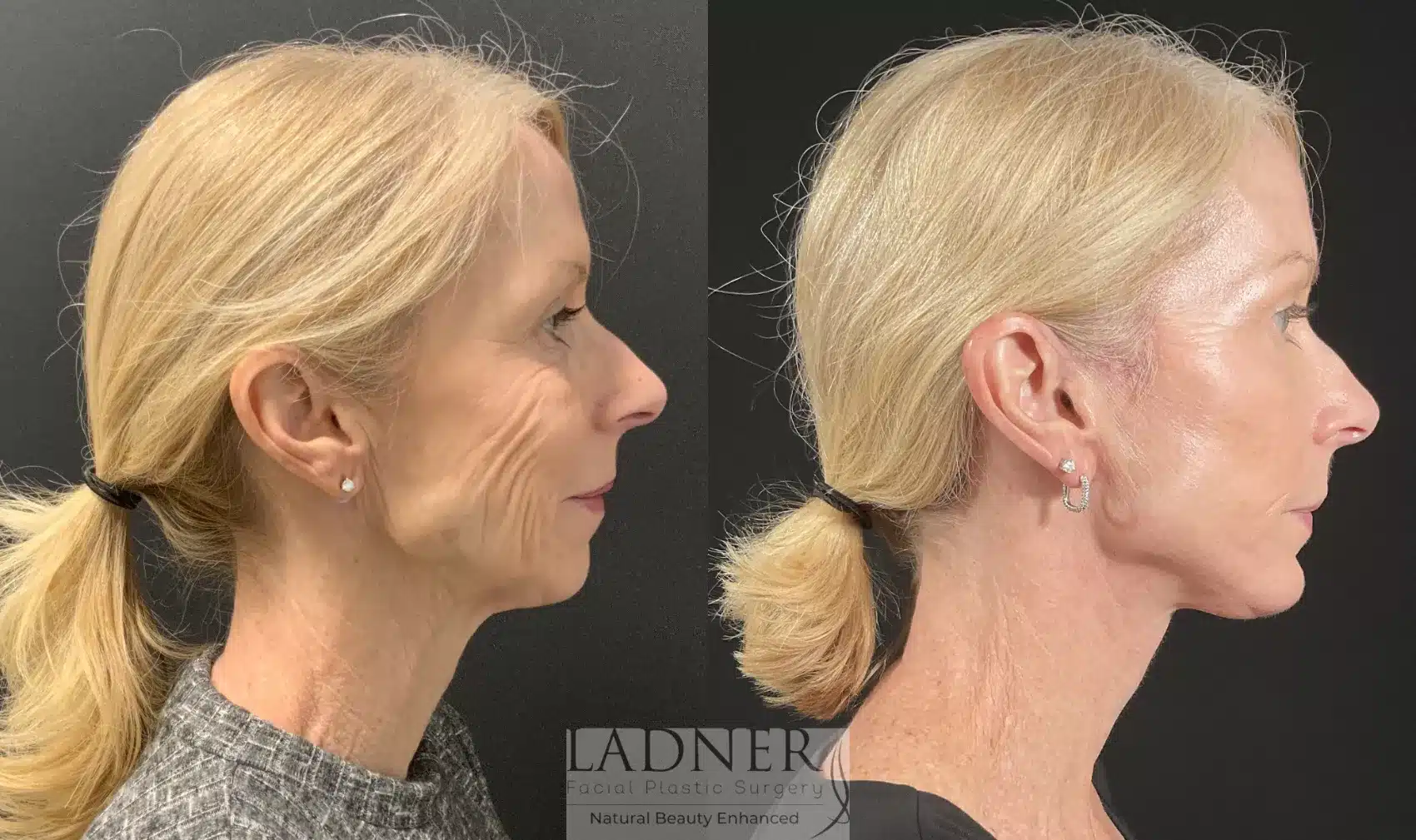 Before and After Image: Deep Plane Facelift - right-side