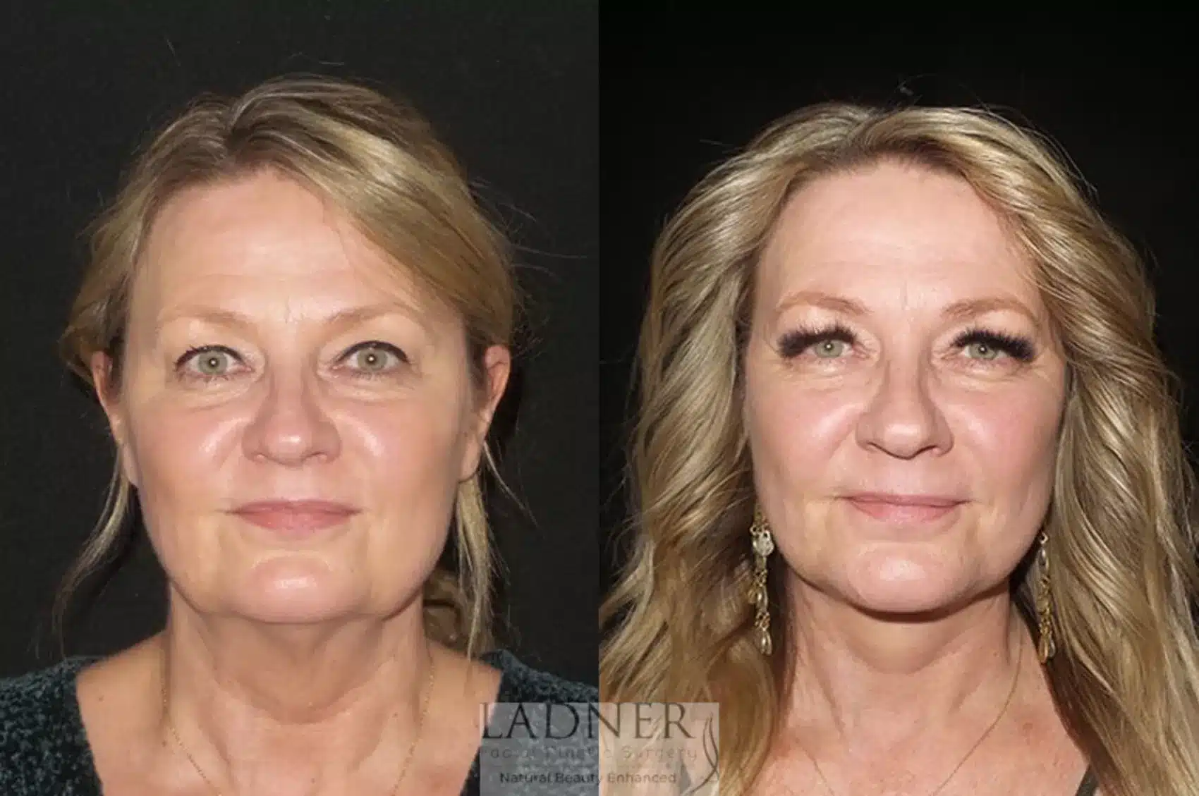 Before and After Image: Lower Deep Plane Face Lift/Neck Lift - front