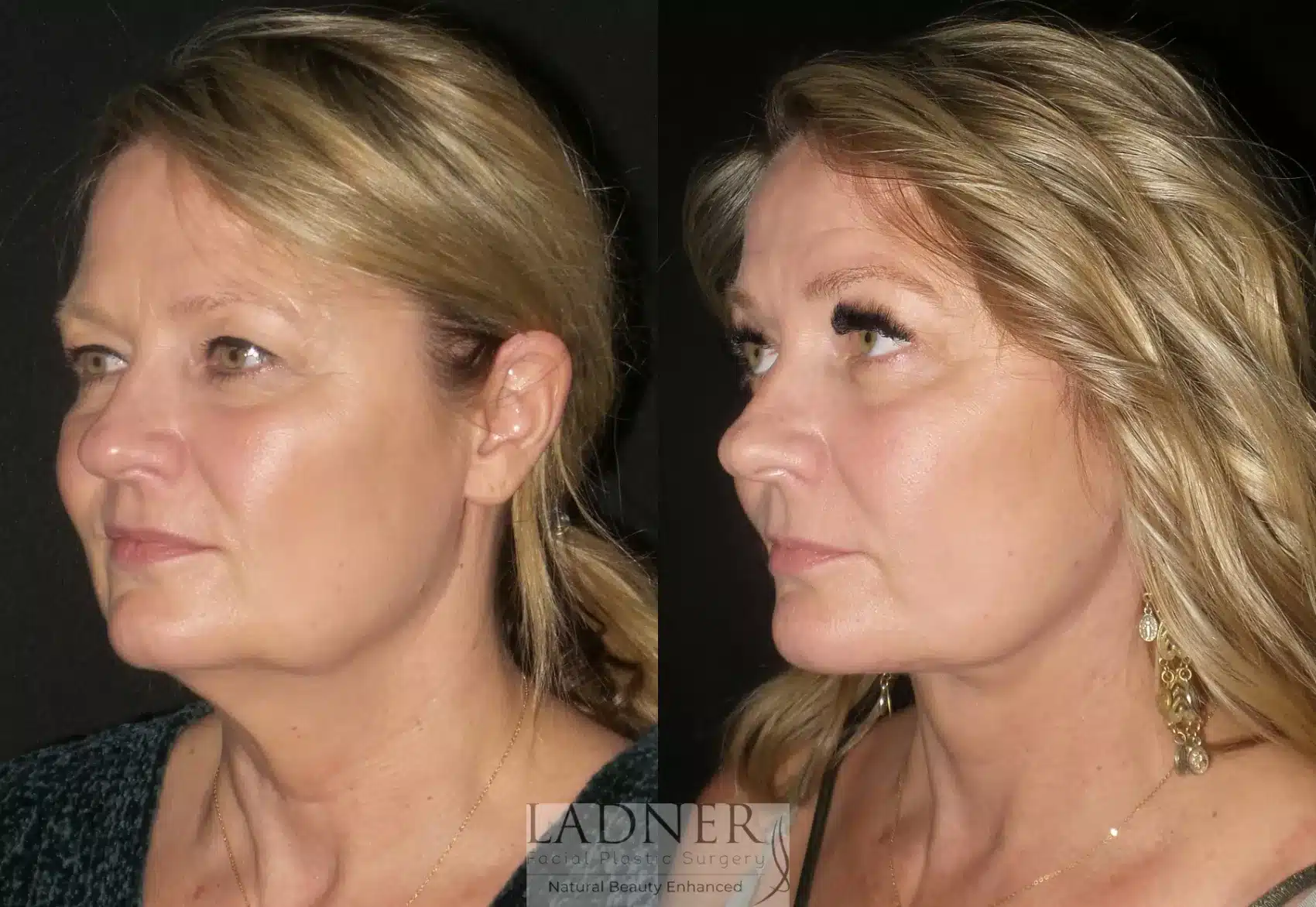 Before and After Image: Lower Deep Plane Face Lift/Neck Lift - left-front-oblique