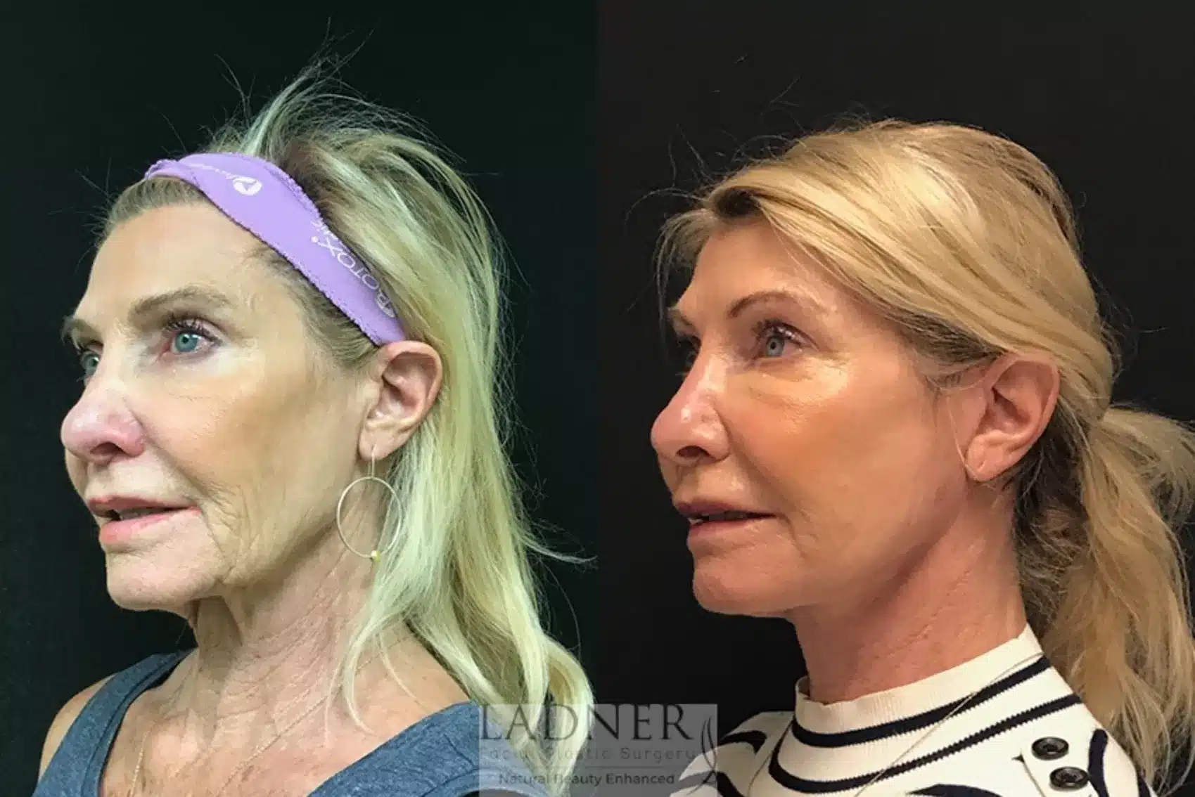 Before and After Image: Deep Plane Facelift - left-front-oblique