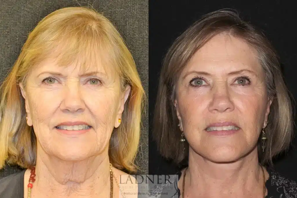 Before and After Image: Deep Plane Neck Lift - front