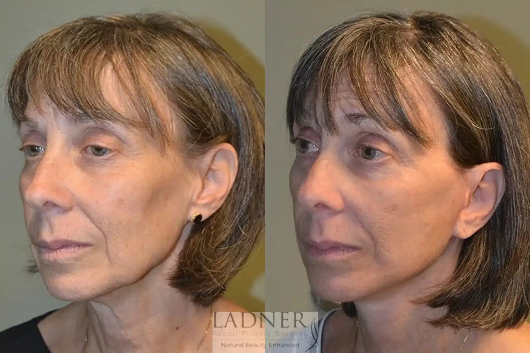 Before and After Image: Deep Plane Facelift/Neck Lift - left-front-oblique