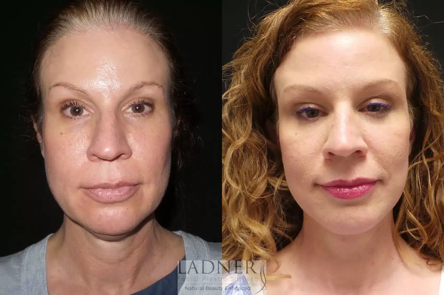 Before and After Image: Deep Plane Face Lift/Neck Lift - front