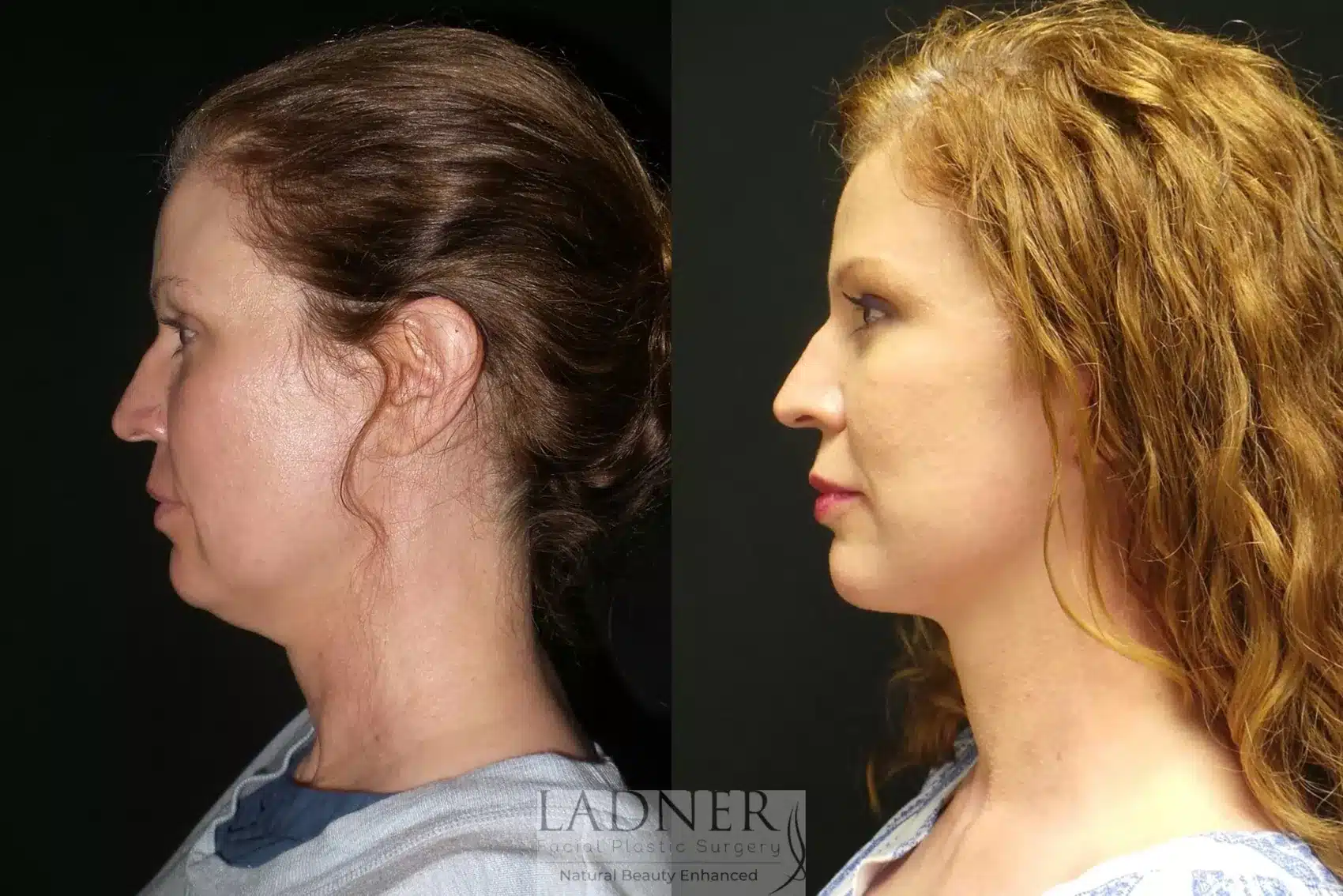 Before and After Image: Deep Plane Face Lift/Neck Lift - left-side