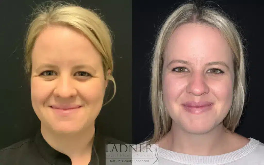 Before and After Image: Brow Lift / Forehead Lift - front
