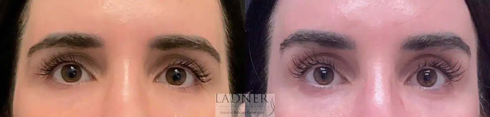 Before and After Image: Brow Lift - front
