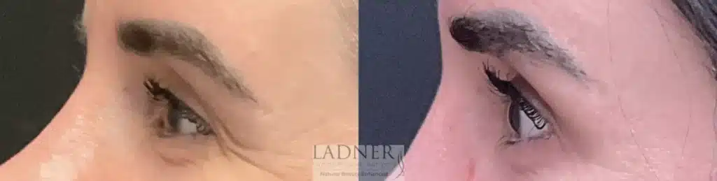 Before and After Image: Brow Lift - left-side