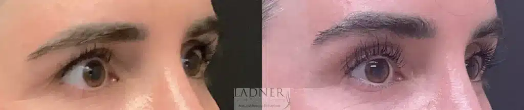 Before and After Image: Brow Lift - right-front-oblique