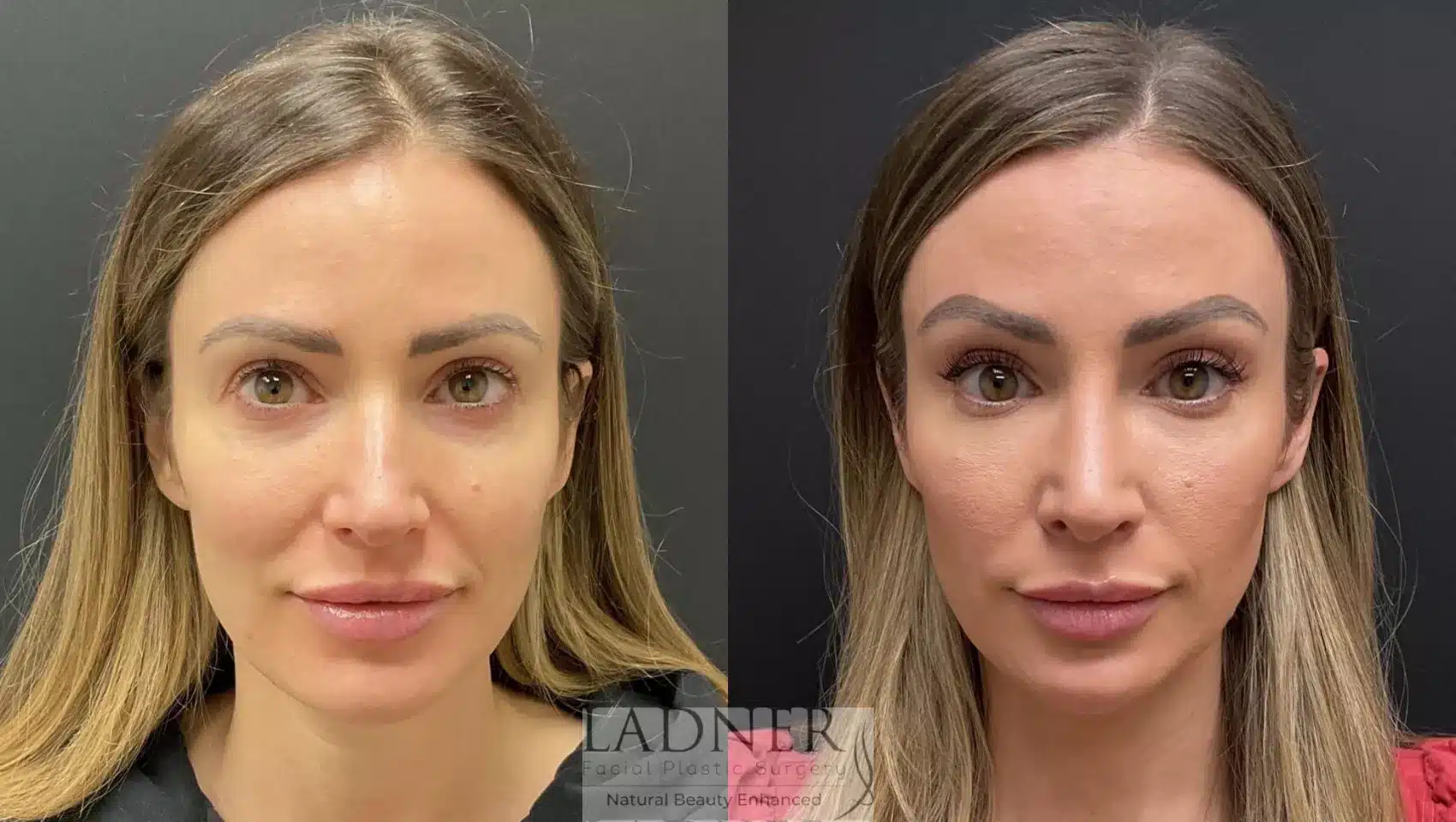 Before and After Image: Brow Lift / Forehead Lift - front