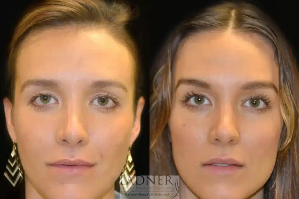 Before and After Image: Brow Lift - front