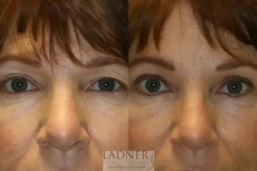Before and After Image: Upper Blepharoplasty & Brow Lift/Forehead Lift - front