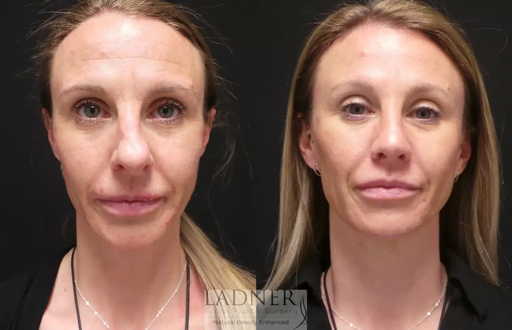 Before and After Image: Open Rhinoplasty & Brow Lift - front