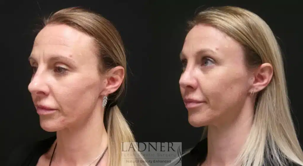 Before and After Image: Rhinoplasty & Brow Lift - left-front-oblique