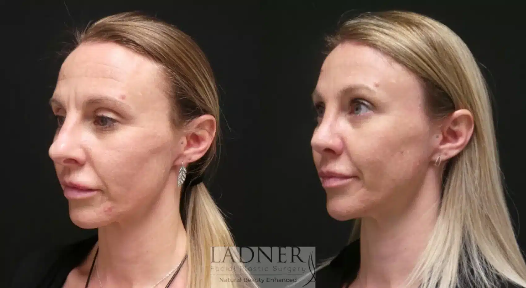 Before and After Image: Open Rhinoplasty & Brow Lift - left-front-oblique