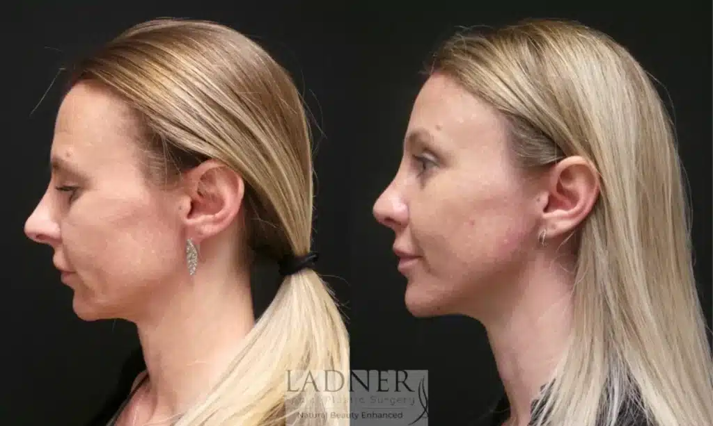 Before and After Image: Rhinoplasty & Brow Lift - left-side