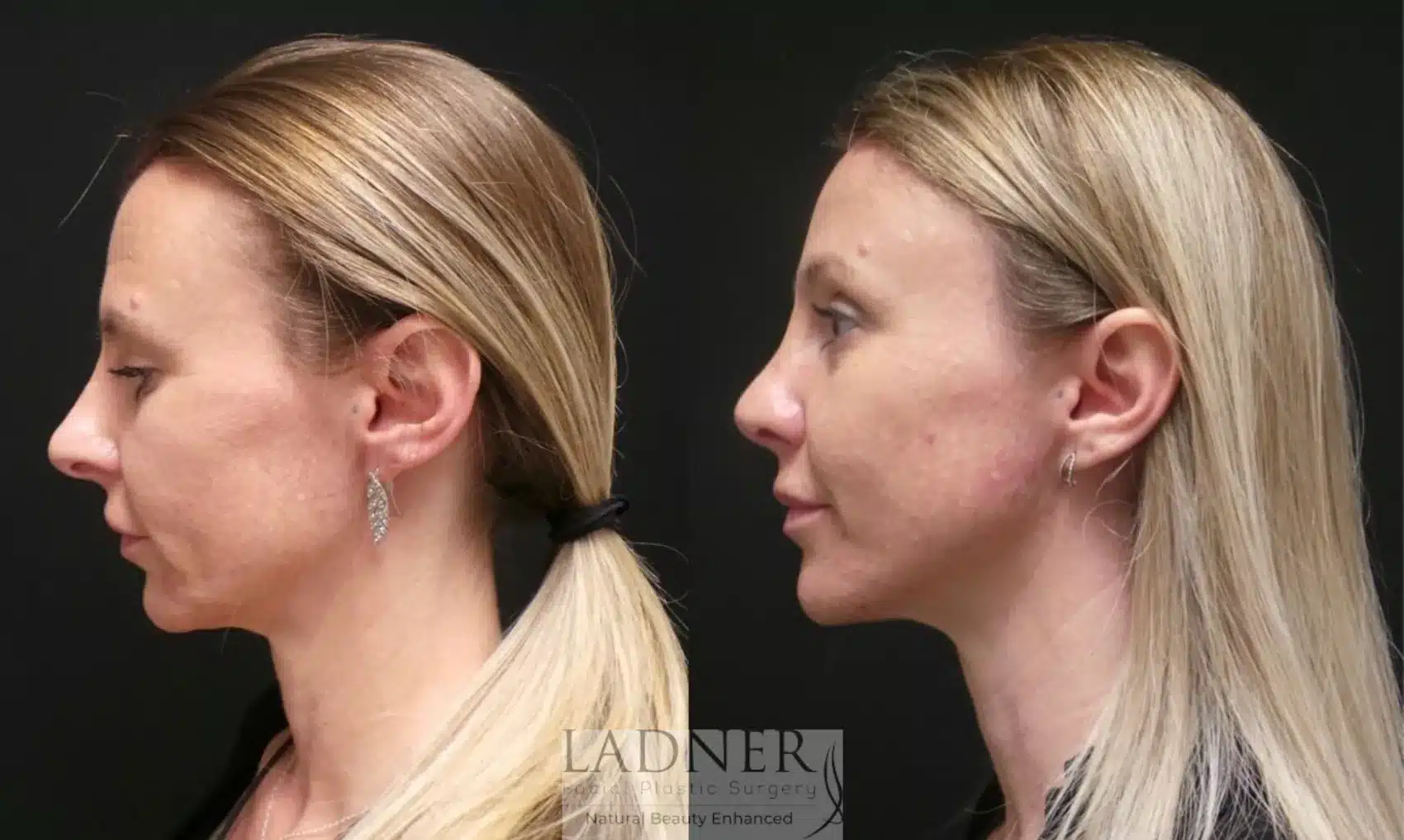 Before and After Image: Open Rhinoplasty & Brow Lift - left-side