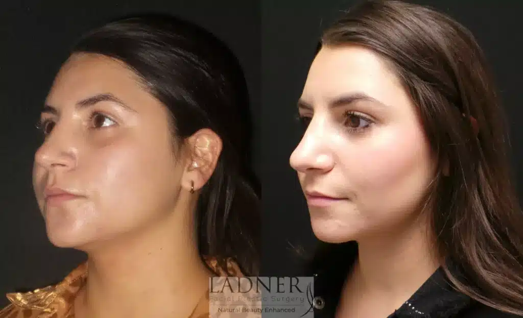 Before and After Image: Buccal Fat Removal - left-front-oblique