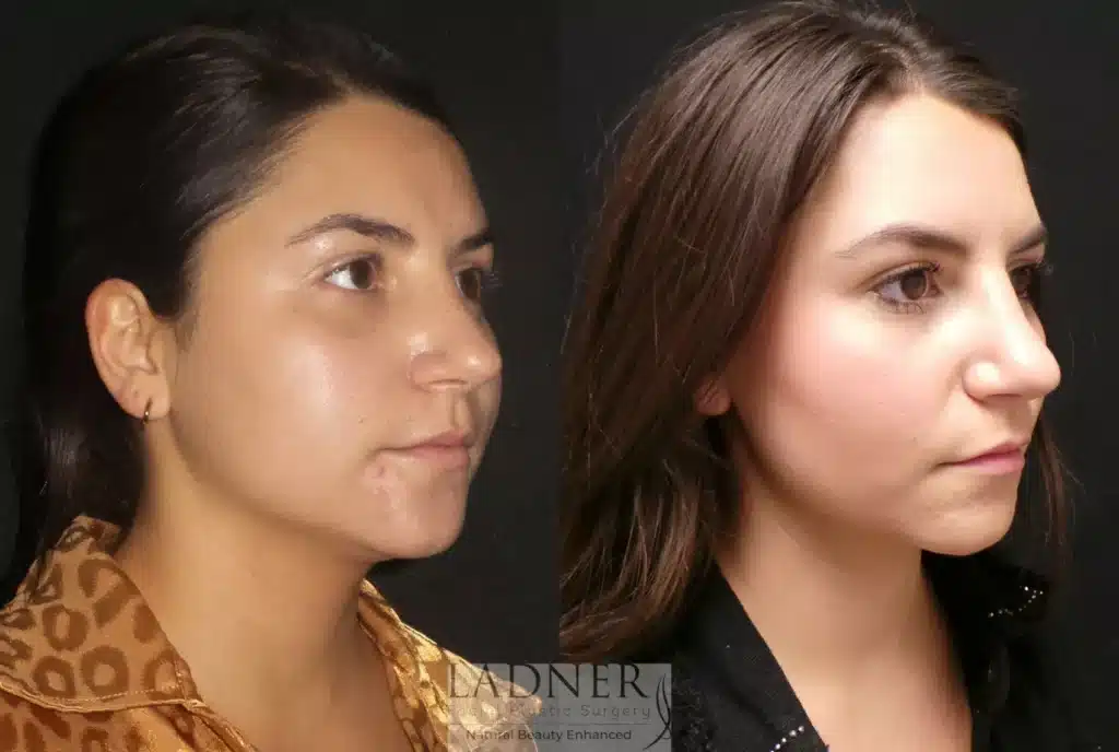 Before and After Image: Buccal Fat Removal - right-front-oblique