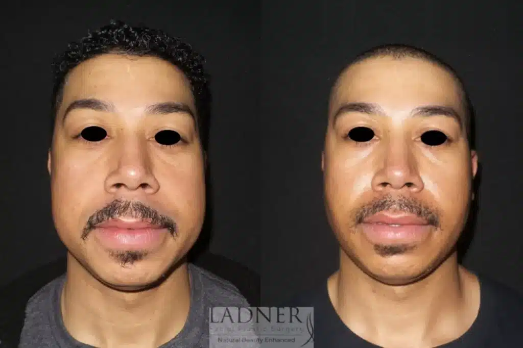 Before and After Image: Buccal Fat Removal & Facial Plastic Surgery for Men - front