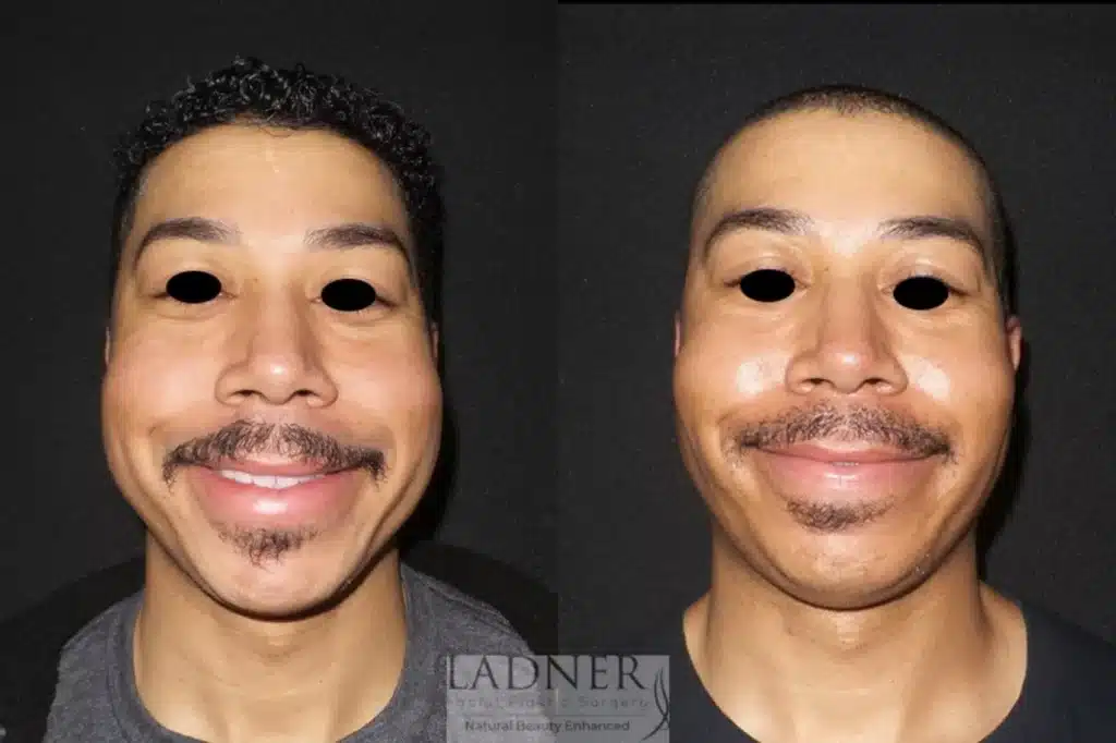 Before and After Image: Buccal Fat Removal & Facial Plastic Surgery for Men - front