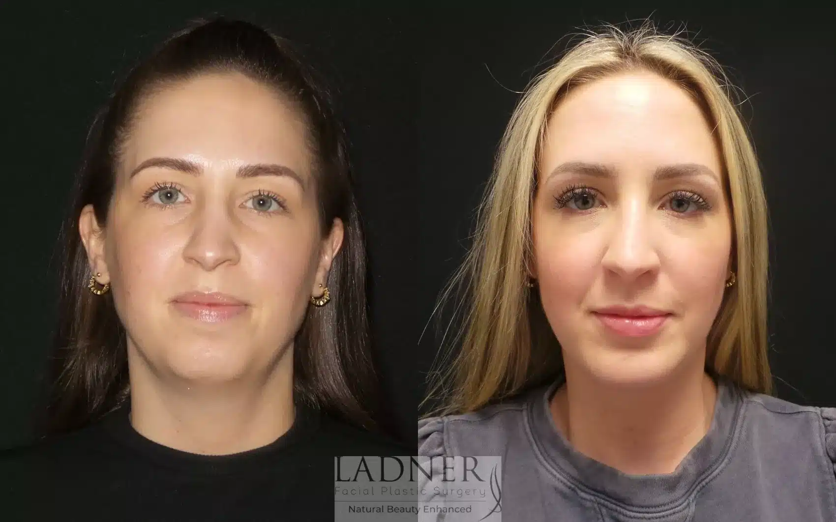 Before and After Image: Chin Augmentation - front