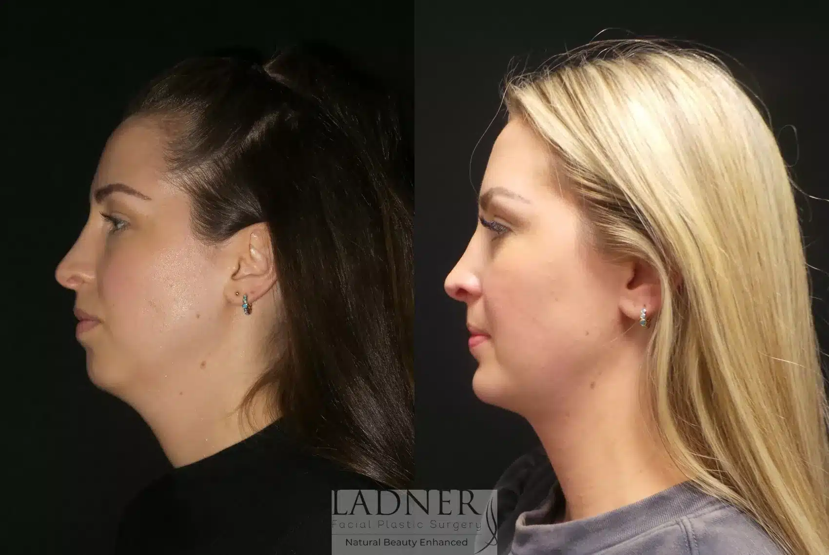 Before and After Image: Chin Augmentation - left-side