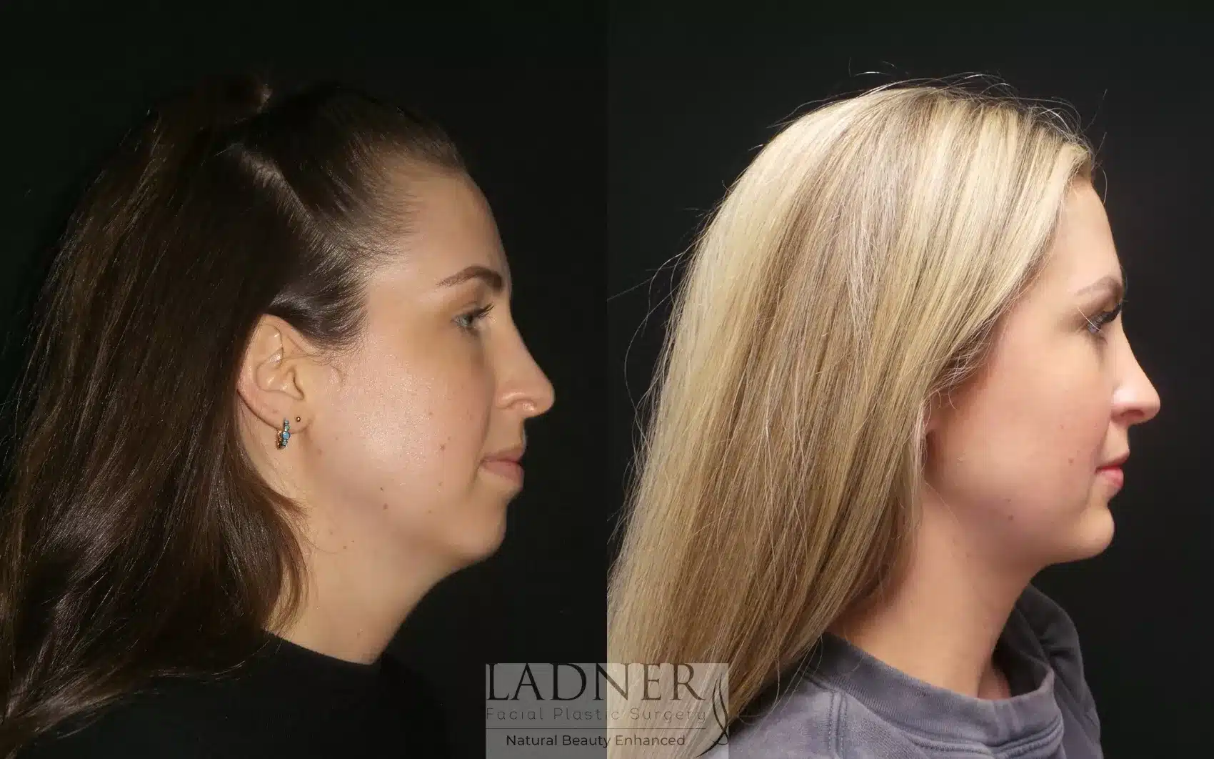 Before and After Image: Chin Augmentation - right-side