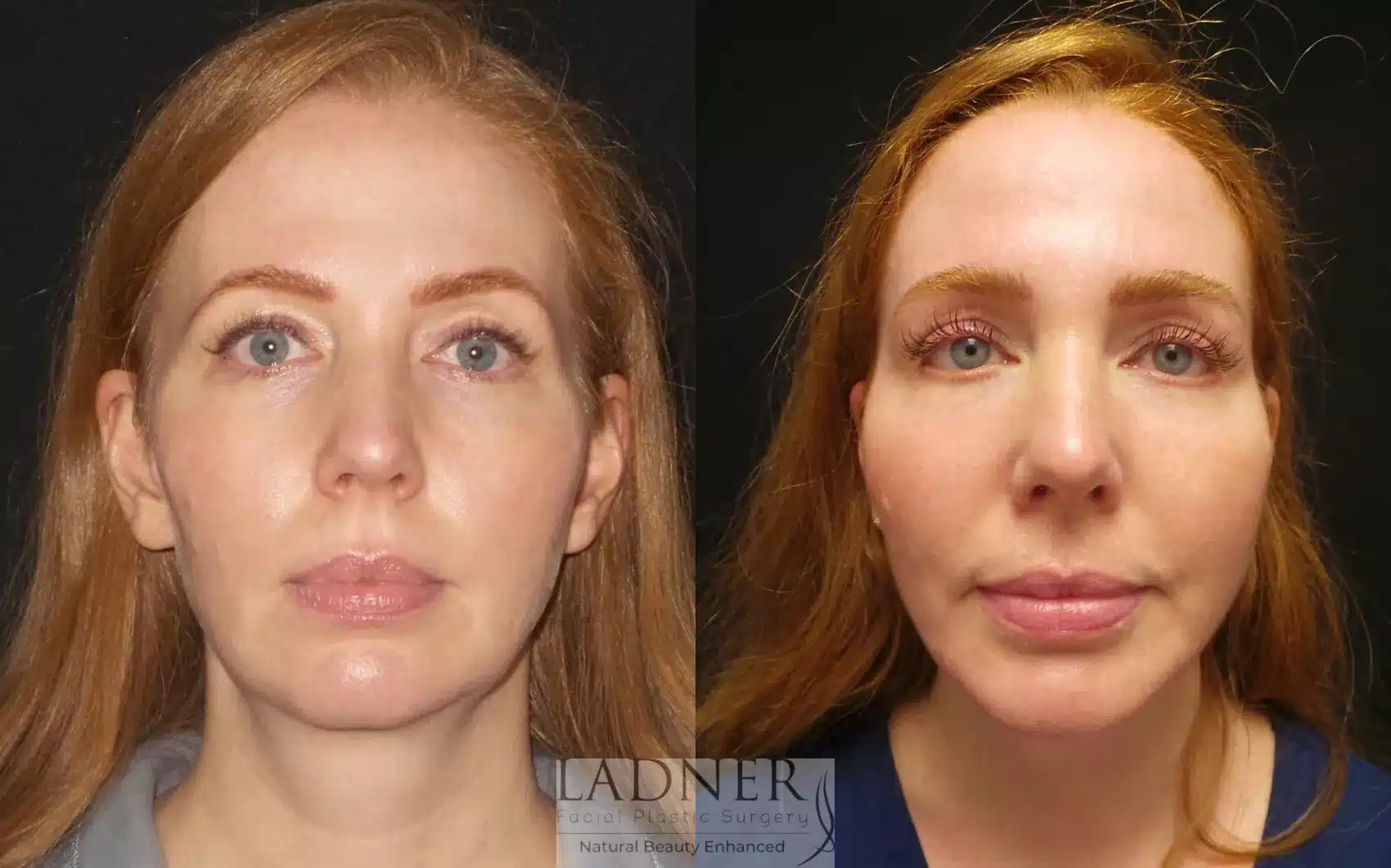 Before and After Image: Chin Augmentation - front
