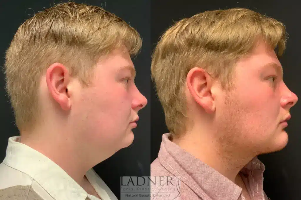 Before and After Image: Minimally Invasive Neck Tightening, Chin Augmentation, and Facial Plastic Surgery - right-side