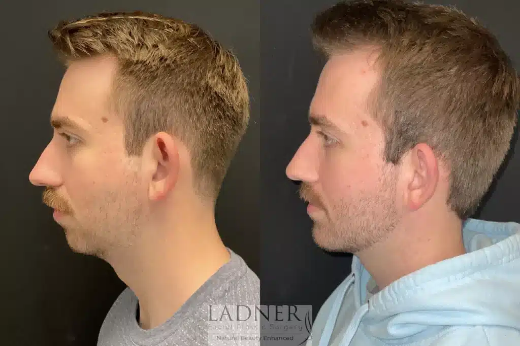 Before and After Image: Chin Augmentation & Facial Plastic Surgery for Men - left-side