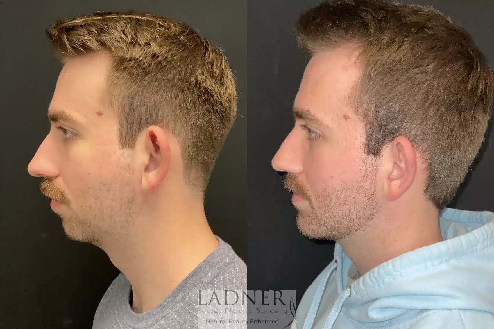 Before and After Image: Chin Augmentation - left-side