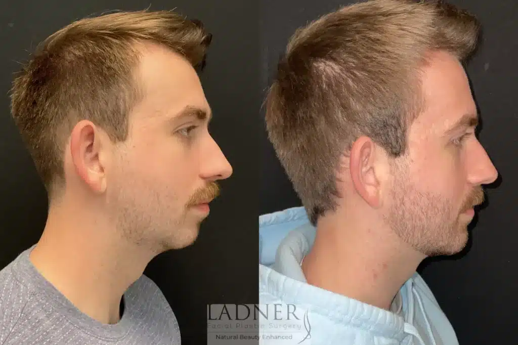 Before and After Image: Chin Augmentation & Facial Plastic Surgery for Men - right-side