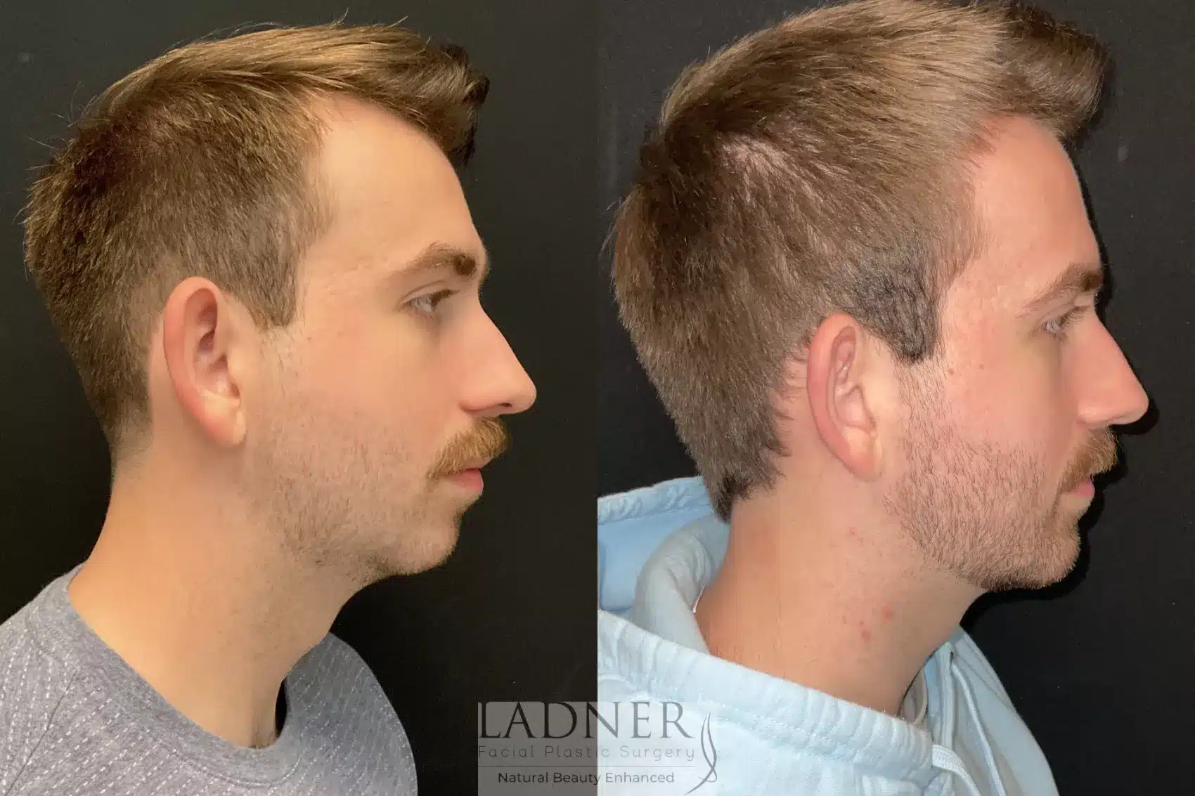 Before and After Image: Chin Augmentation - right-side