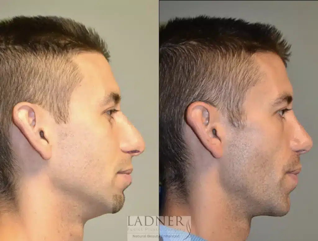 Before and After Image: Rhinoplasty, Chin Augmentation, and Facial Plastic Surgery for Men - right-side