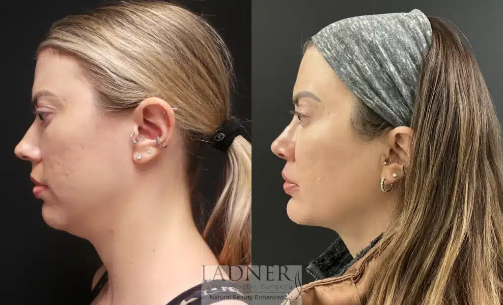Before and After Image: Minimally Invasive Neck Tightening & Chin Augmentation - left-side