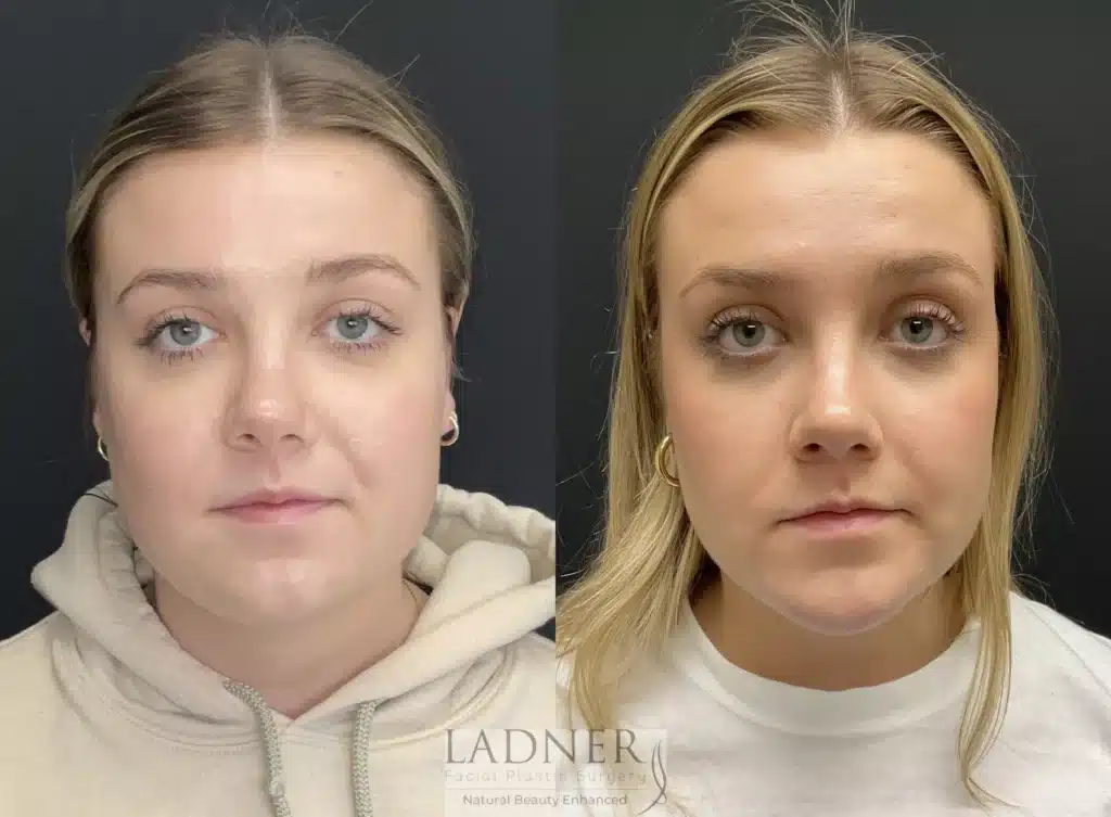 Before and After Image: Submental Liposuction, Chin Augmentation, Buccal Fat Removal - front