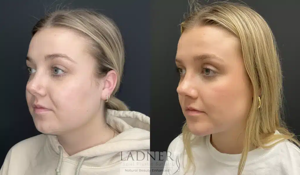 Before and After Image: Submental Liposuction, Chin Augmentation, Buccal Fat Removal - left-front-oblique