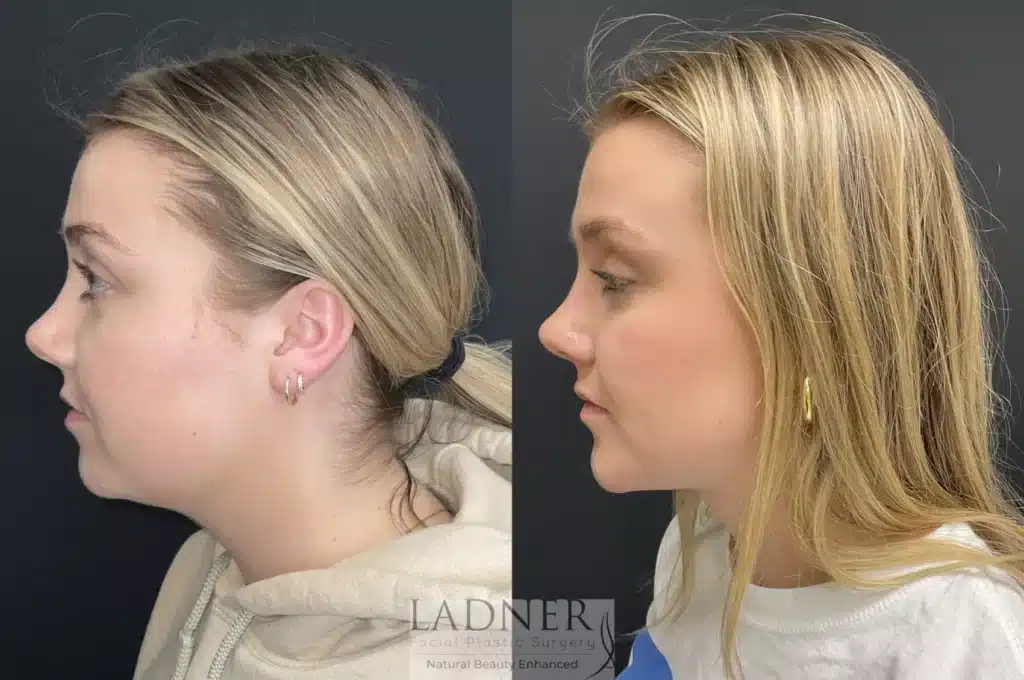 Before and After Image: Submental Liposuction, Chin Augmentation, Buccal Fat Removal - left-side